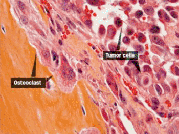 Image: Researchers at Princeton University have found that microRNAs may serve as both therapeutic targets and predictors of metastasis. In this image, breast cancer cells (right) spread toward the hindlimb bone (left), using the host's own osteoclasts to continue their advance (Photo courtesy of Dr. Yibin Kang, Princeton University).